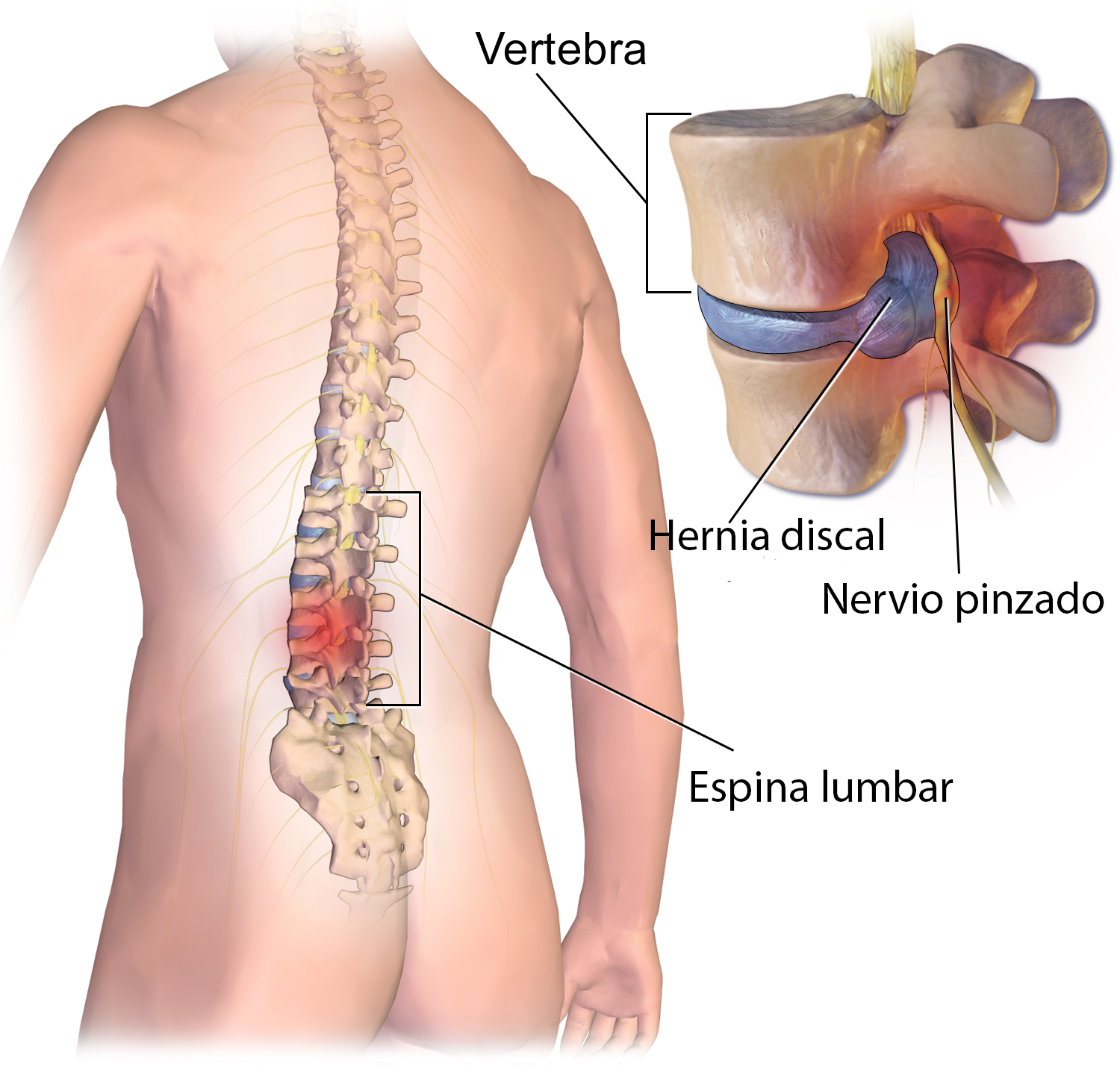 Hernia de disc: cauze, simptome si tratament